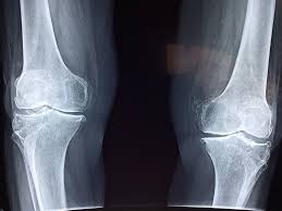 Top Reasons to Visit an Orthopedic Doctor knee x-ray image